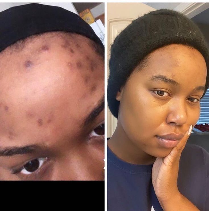 Kojic Acid & Turmeric Soap